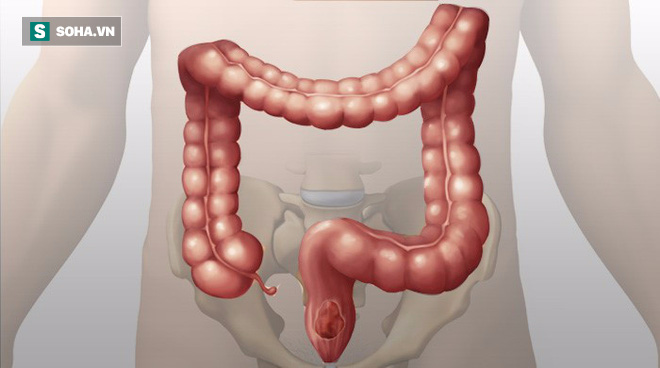 Cái chết bắt nguồn từ đại tràng: Rửa sạch độc tố trong đại tràng chỉ bằng cách ăn uống - Ảnh 1.