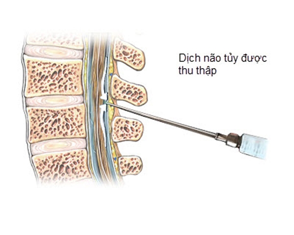 Không chấp nhận con bị tâm lý, cha mẹ đi chọc tủy con để tìm bệnh - Ảnh 1.