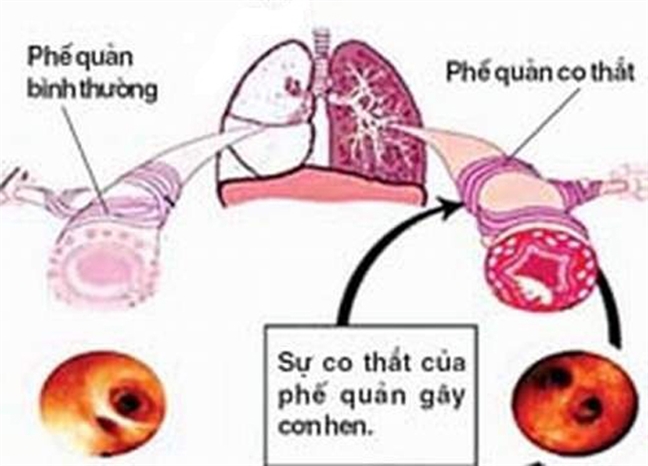 Kỳ lạ bệnh nhân ho một lần phun ra gần 1 lít máu - Ảnh 1.