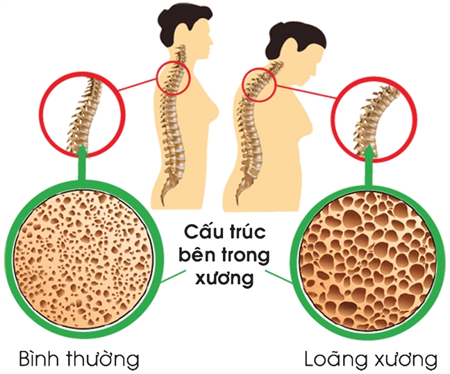 Tuổi bẻ gãy sừng trâu cũng… liệt giường vì loãng xương - Ảnh 1.