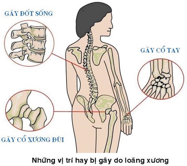 Tuổi bẻ gãy sừng trâu cũng… liệt giường vì loãng xương - Ảnh 2.