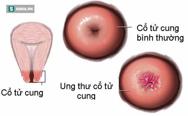 32 tuổi tử vong vì bệnh ung thư vì ngại khám phụ khoa: Lời cảnh báo cho tất cả chị em - Ảnh 2.