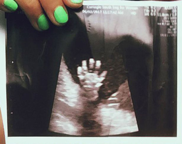 Nằm trong bụng mẹ, thai nhi 20 tuần tuổi giơ bàn tay năm ngón vẫy chào - Ảnh 2.