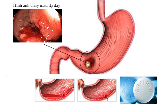 Loại thuốc hạ sốt nào không được dùng khi sốt xuất huyết? - Ảnh 1.