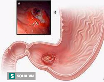 Nếu có dấu hiệu sau cần đi khám ngay, để muộn có thể bị thủng dạ dày - Ảnh 2.