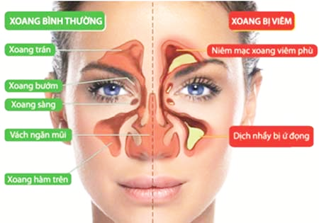 Cách đơn giản tự chữa viêm xoang - Ảnh 2.