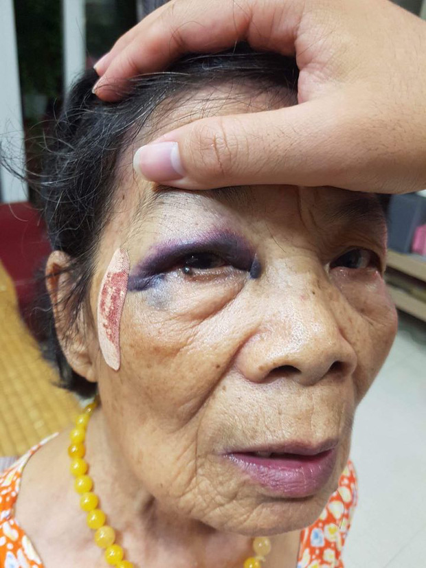 Hà Nội: Bà cụ 80 tuổi bị ô tô đâm bầm tím mắt và tay, tài xế vờ xuống xem rồi viện lý do để bỏ chạy - Ảnh 2.