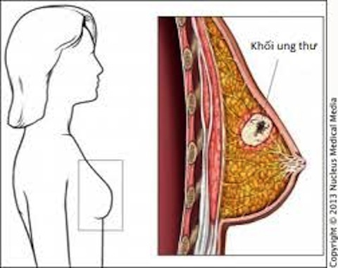 Chỉ đứng trước gương khi tắm, cô gái trẻ phát hiện ra bệnh ung thư - Ảnh 1.