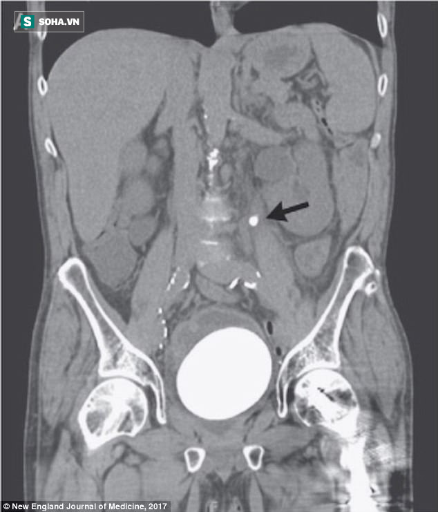 Người đàn ông có sỏi to bằng trứng đà điểu trong bàng quang: Quý ông trên 50 phải lưu ý - Ảnh 1.