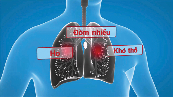 Phòng tái phát viêm phế quản mạn tính - Ảnh 1.