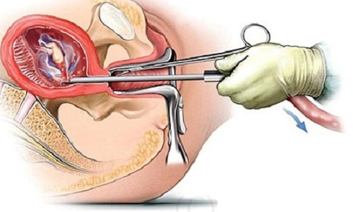 Có thai ngoài ý muốn ở trẻ vị thành niên: Phòng tránh thế nào? - Ảnh 1.