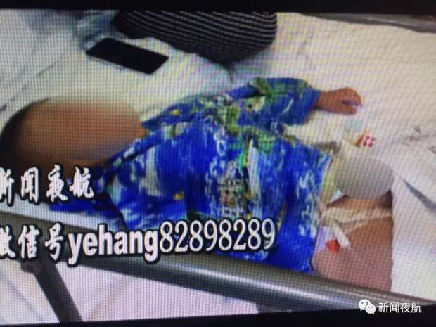 Bé trai 2 tuổi bị bỏng bộ phận sinh dục vì tè dầm khi ngủ trên thảm điện - Ảnh 2.