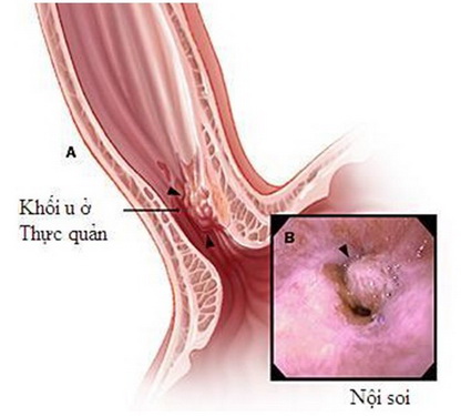 Dấu hiệu sớm của ung thư thực quản - Ảnh 1.