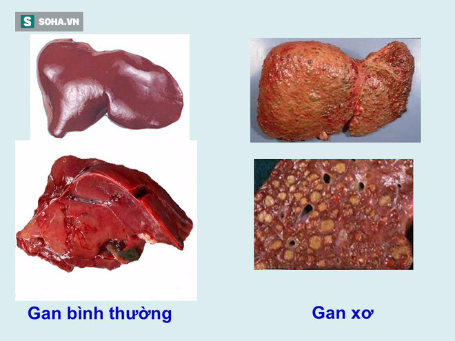 Mắt mía + nước dừa chữa xơ gan cổ trướng: Bài thuốc vô căn cứ! - Ảnh 1.