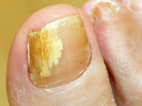 Những dấu hiệu ở móng chân, móng tay bạn nhất định phải để ý kẻo mang bệnh  không biết