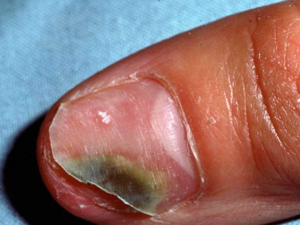 Những dấu hiệu ở móng chân, móng tay bạn nhất định phải để ý kẻo mang bệnh không biết - Ảnh 5.