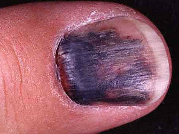 Những dấu hiệu ở móng chân, móng tay bạn nhất định phải để ý kẻo mang bệnh không biết - Ảnh 6.