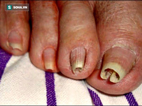 Những dấu hiệu ở móng chân, móng tay bạn nhất định phải để ý kẻo mang bệnh không biết - Ảnh 11.