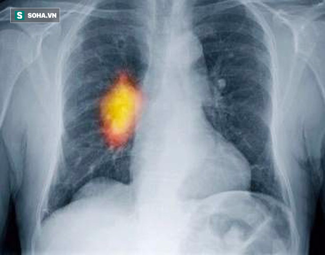 Nghi ngờ bị ung thư phổi, bác sĩ phát hiện điều bất ngờ về nguyên nhân gây ra khối u - Ảnh 1.