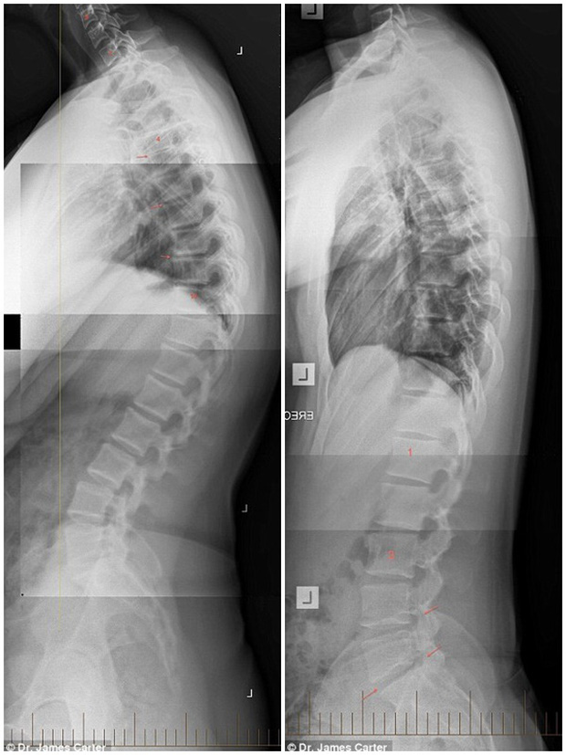 Xem quy trình phẫu thuật nắn cột sống đau nhức nhối khiến bạn chẳng bao giờ dám ngồi sai tư thế nữa - Ảnh 1.