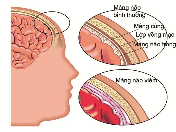 Những điều cần biết về viêm màng não - Căn bệnh có thể tấn công bất kỳ ai - Ảnh 1.