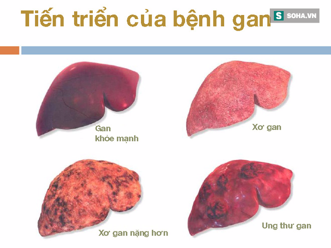 Dấu hiệu quan trọng cảnh báo bệnh gan đang tiến triển trong cơ thể, nếu có thì hãy đi khám - Ảnh 1.