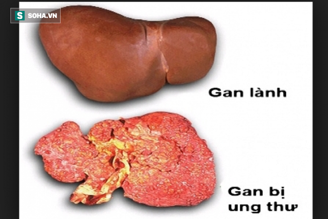 Xét nghiệm máu mới phát hiện sớm ung thư gan, tăng tỷ lệ sống sót cho bệnh nhân - Ảnh 2.