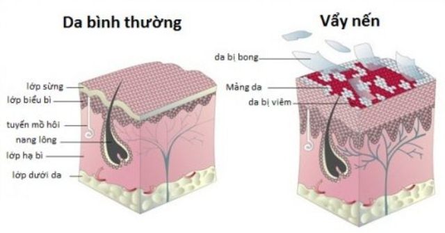 Khổ sở vì căn bệnh gây xấu xí, ngứa ngáy không dứt - Ảnh 1.