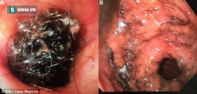Bác sĩ hoảng hốt khi phát hiện búi tóc đóng cục trong bụng bệnh nhân - Ảnh 2.