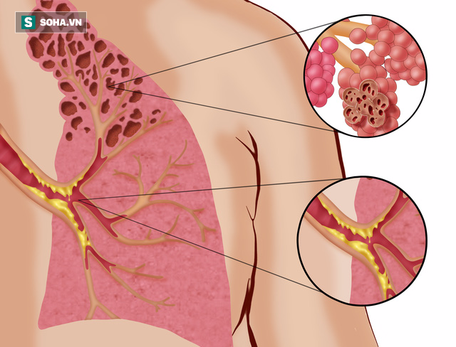 Nam giới muốn khỏe, trước hết đừng để gan, phổi, dạ dày có bệnh: Đây là 3 điều nên làm! - Ảnh 4.