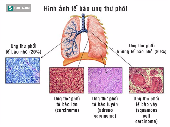 Bé trai 2 tuổi bị ung thư phổi: Liệu chúng ta có quá chậm chân trong việc phòng bệnh? - Ảnh 3.