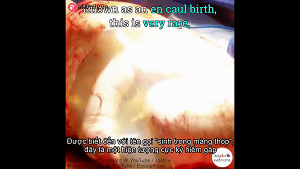 Cận cảnh em bé chào đời trong một ca sinh mổ hiếm gặp chỉ xảy ra với xác xuất 1/80.000 ca - Ảnh 2.