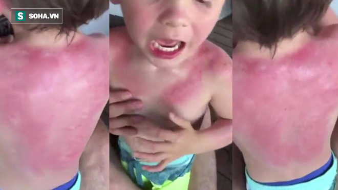 Bé trai 3 tuổi dị ứng, bỏng da nặng sau khi bôi kem chống nắng - Ảnh 1.
