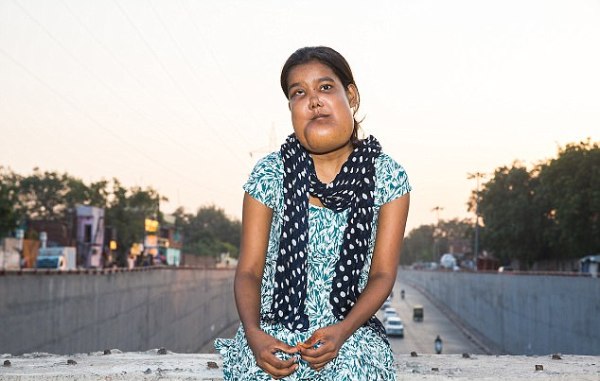 Ấn Độ: Căn bệnh quái ác khiến thiếu nữ mang khuôn mặt của quỷ dữ và bị cả xã hội ruồng bỏ - Ảnh 1.