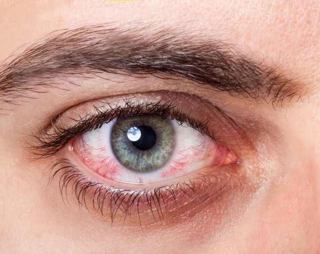 Có thể bị mù vĩnh viễn nếu mắt có dấu hiệu này mà mặc kệ không đi khám - Ảnh 2.
