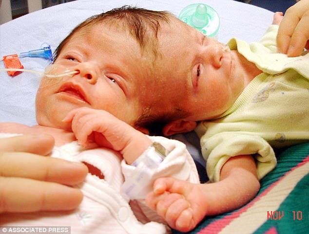 Hai bé sinh đôi dính liền đầu bác sĩ nói sau 1 ngày là chết, và đây là hình ảnh sau 11 năm - Ảnh 1.
