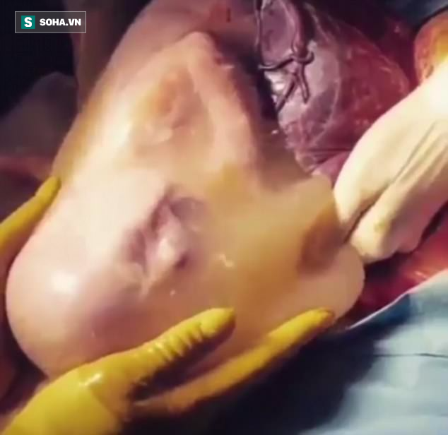 Video: Tận mắt chứng kiến bé chào đời vẫn cựa quậy trong túi ối cực hiếm - Ảnh 1.