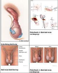 Xoắn tinh hoàn có đáng sợ? - Ảnh 1.