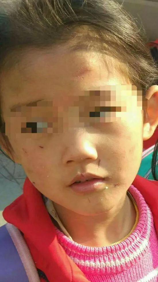Bé gái 6 tuổi bị mẹ đẻ ngược đãi dã man khiến mặt đầy vết thương, tóc rụng thành mảng lớn - Ảnh 1.