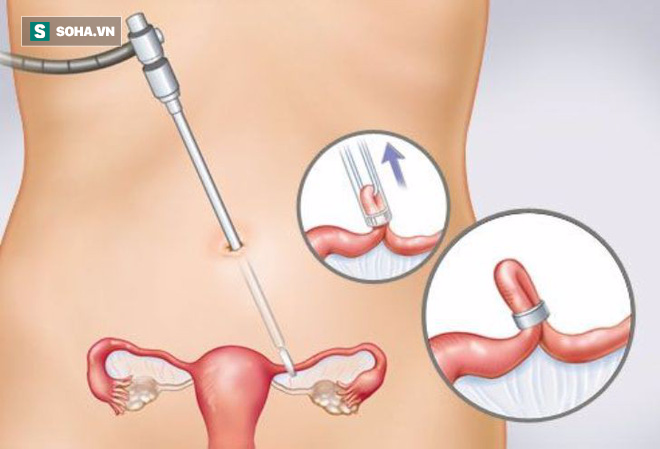 Thai phụ triệt sản rồi vẫn có bầu, bác sĩ nói không nhớ có triệt sản được hay không - Ảnh 2.