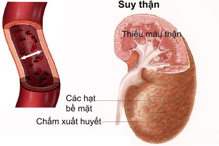 Dấu hiệu bệnh thận và suy thận - Ảnh 1.