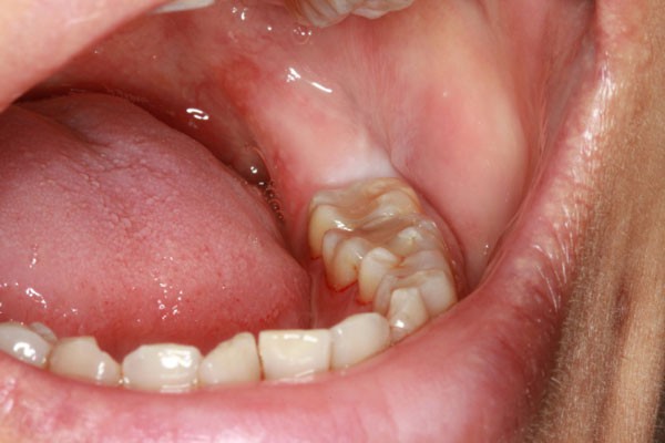 Đây là những cách để giảm sự hoành hành của chiếc răng ngu - Ảnh 2.