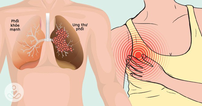 Không chỉ có ho, đây là 5 dấu hiệu lén lút của bệnh ung thư phổi nhiều người chưa biết - Ảnh 1.