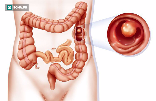 4 nhóm người buộc phải khám ung thư để tiêu diệt mầm bệnh ngay từ trong trứng nước - Ảnh 2.