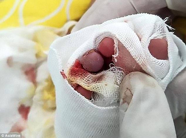Ngón chân bé trai 2 tháng tuổi bị hoại tử, có nguy cơ phải cắt bỏ chì vì 1 sợi tóc vương vãi - Ảnh 1.