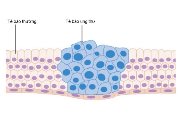 Bạn có biết một bộ phận trên cơ thể chúng ta hầu như không bao giờ bị ung thư? - Ảnh 3.