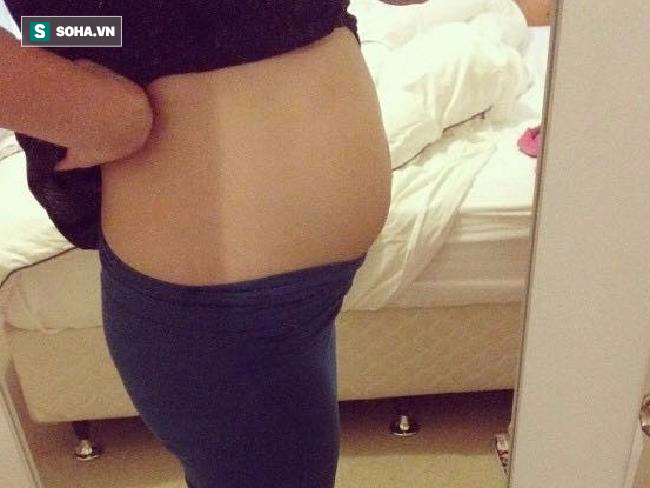 Bị ung thư bụng phình to tưởng loét dạ dày: Cô gái Úc cảnh báo 4 triệu chứng đặc biệt - Ảnh 2.