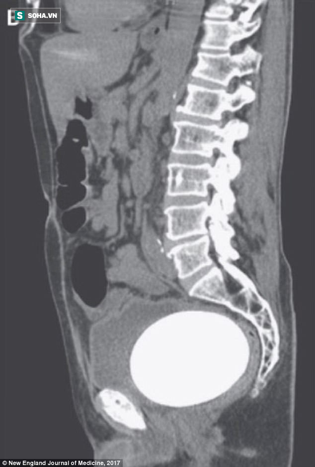 Người đàn ông có sỏi to bằng trứng đà điểu trong bàng quang: Quý ông trên 50 phải lưu ý - Ảnh 2.