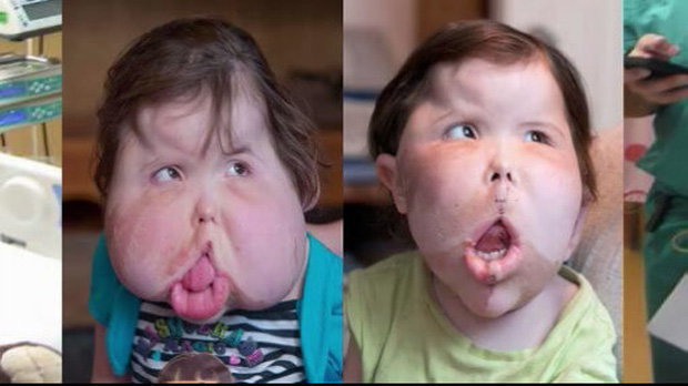 Mắc bệnh hiếm cả bác sĩ cũng chưa đặt tên, bé gái 9 tuổi mang gương mặt khổng lồ biến dạng - Ảnh 3.
