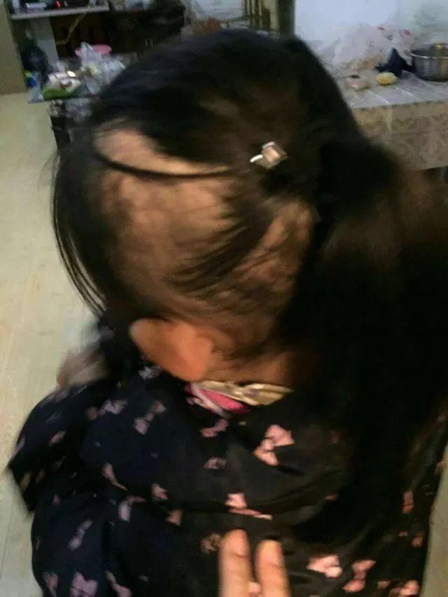 Bé gái 6 tuổi bị mẹ đẻ ngược đãi dã man khiến mặt đầy vết thương, tóc rụng thành mảng lớn - Ảnh 3.